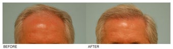 Hair Transplant before 134764