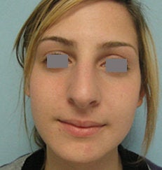 Rhinoplasty before 132705