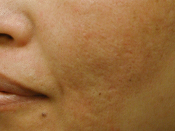 Acne Scars 200602