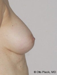Nipple Reduction after 565836