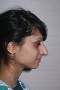 Asian Rhinoplasty before 448668