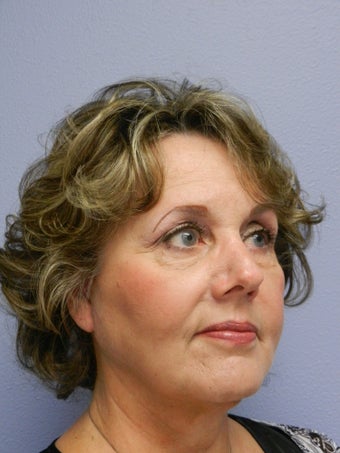 Neck Lift after 598886