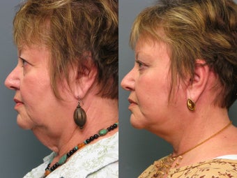 Brow Lift after 338628