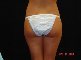 Buttocks Augmentation before 203387