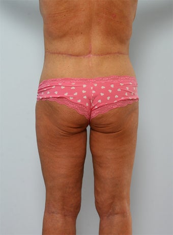 Body Lift after 260129