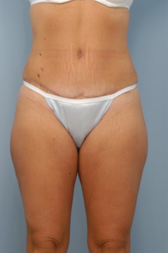 Tummy Tuck with Liposuction after 347794