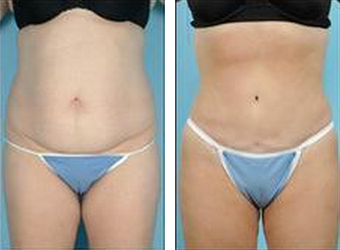 Tummy Tuck (Abdominoplasty) before 324853