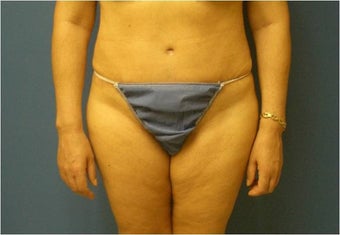 Abdominoplasty, Tummy Tuck, Liposuction after 401748