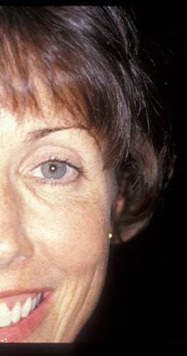 Botox after 469308