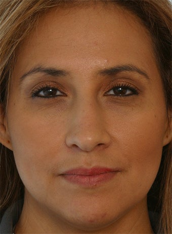 Non Surgical Rhinoplasty Juvederm Ultra Plus after 260327
