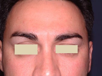 Botox after 93216