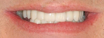 Dental implants, all porcelain crowns after 503161