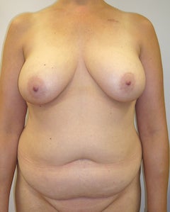 DIEP Flap Breast Reconstruction - Bilateral before 295193