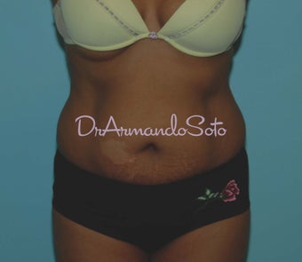 Abdominoplasty (Tummy Tuck) before 122891