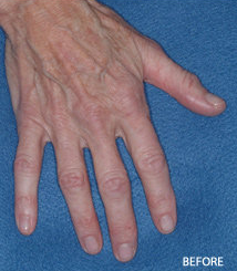 Radiesse Filler Augmentation of the Hands before 328103