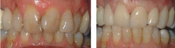 Veneers for an older patient before 607250