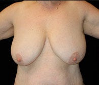 Breast Lift before 633839