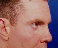 Facial Fat Grafting before 75986