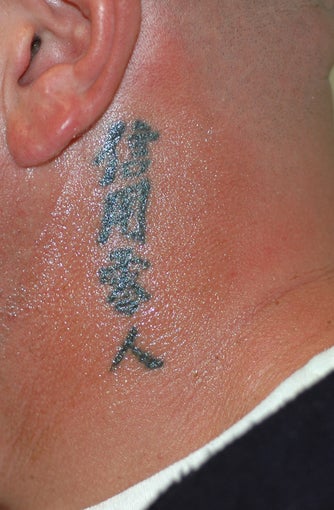 Tattoo Removal Before and After Pictures before 413954