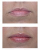 Juvederm before 82773