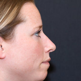 Rhinoplasty (Hump & Tip) after 572877