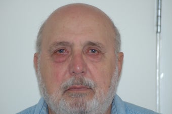 Lower eyelid surgery or lower blepharoplasty before 366300