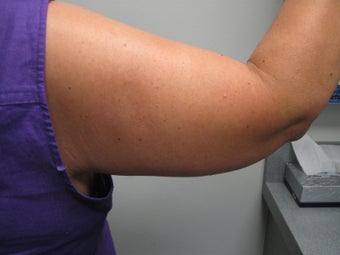 Arm Lift 389008