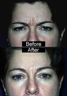 Botox before 97310