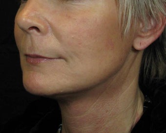 Facelift after 246960