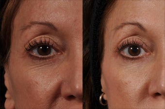 Ultherapy before 541135
