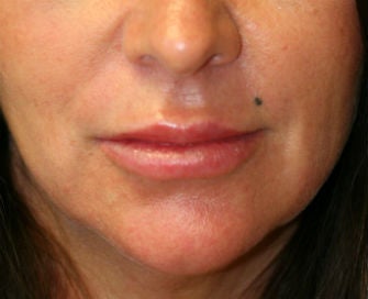 Lip Augmentation with Permalip after 380417