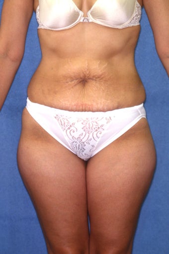 Tummy Tuck with Liposuction before 410983