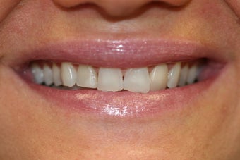 veneer and crown work before 558816