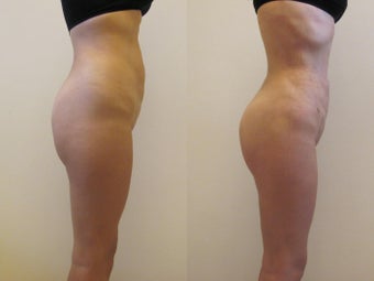 Brazilian butt lift after 247113