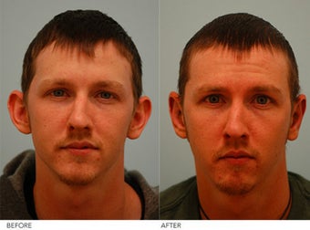 Otoplasty before 197286
