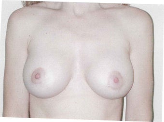 Breast lift with augmentation after 633947