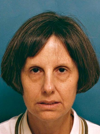 Facelift, Endoscopic Browlift, Bilateral Lower Blepharoplasty before 248879