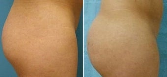 Buttock Augmentation before 110106