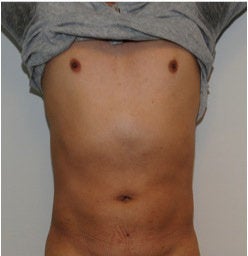 Smartlipo Abdomen after 123636