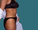 Tummy Tuck 542650