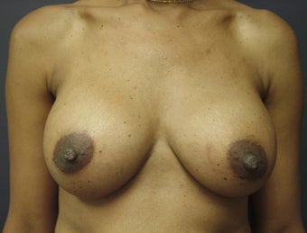 Breast Augmentation after 465538