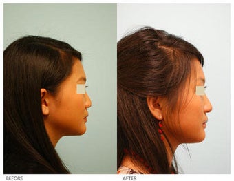 Asian Rhinoplasty before 136824
