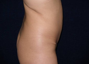 Tummy Tuck Revision before 550597