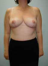Breast Reduction after 96851