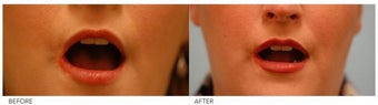 Lip Reduction/Lip Correction before 136734