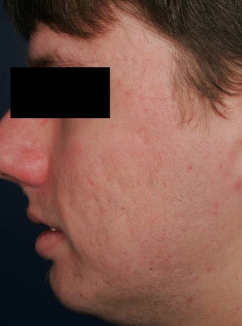 Fraxel - acne scars after 136199