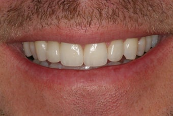 Tooth replacement in the smile after 382033