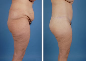 Lower Body Lift and Liposuction of Lateral Thighs 303681
