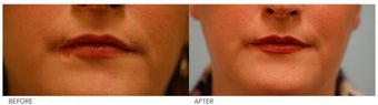 Lip Reduction/Lip Correction after 136734