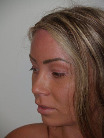 Surgical Hairline Advancement Procedure 535779